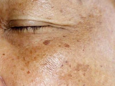 Xóa Mờ Nám – Lấy Lại Làn Da Rạng Rỡ Chỉ Với Một Liệu Trình Phù Hợp
