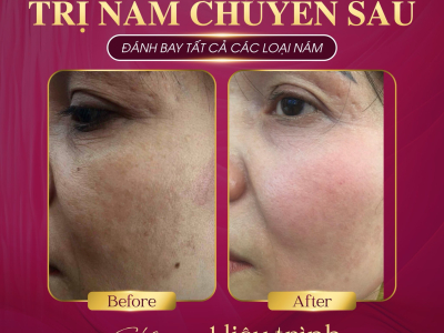 Trị nám da