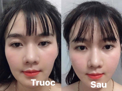 album Cấy HA xóa nhăn