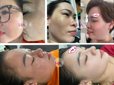 Dịch vụ điều trị nám