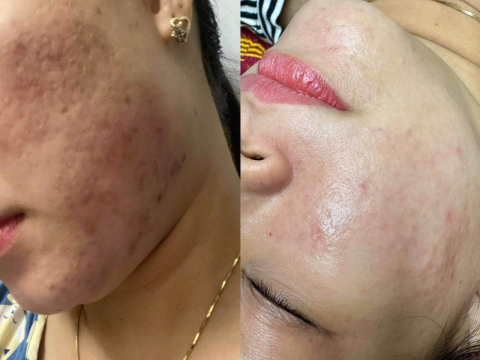 Dịch vụ điều trị nám