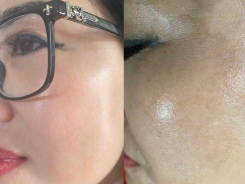 Dịch vụ điều trị nám