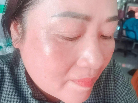 Dịch vụ điều trị nám