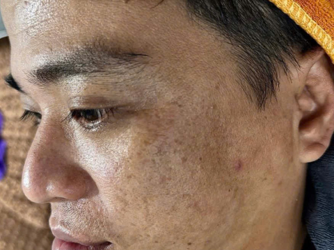 Dịch vụ điều trị nám