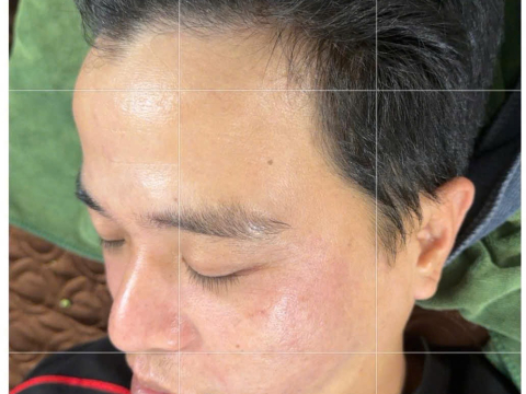 Dịch vụ điều trị nám