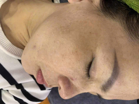 Dịch vụ điều trị nám