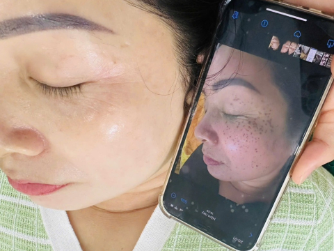 Dịch vụ điều trị nám