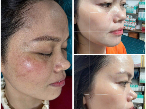 Dịch vụ điều trị nám