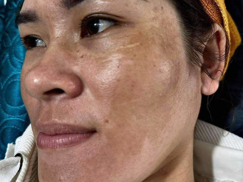 Dịch vụ điều trị nám