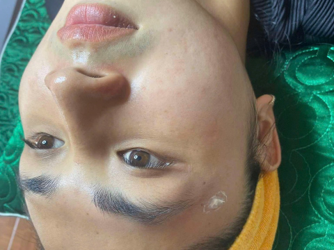 Dịch vụ điều trị nám