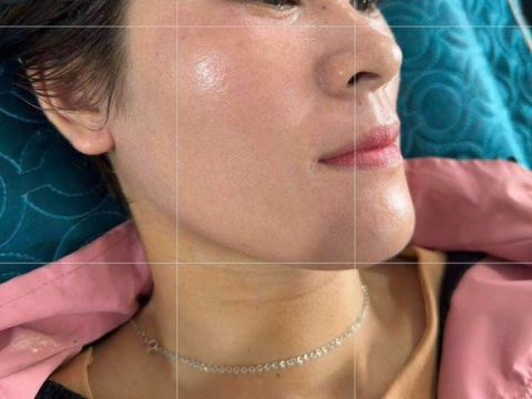 Dịch vụ điều trị nám