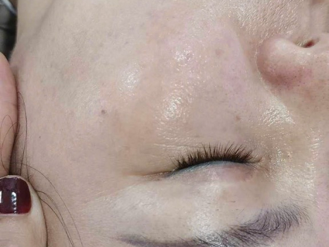 Dịch vụ điều trị nám
