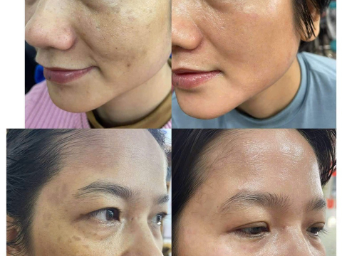 Dịch vụ điều trị nám