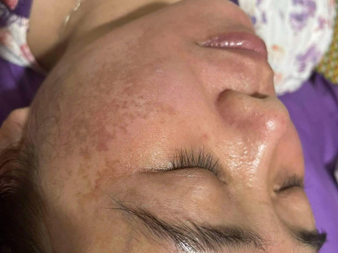 Dịch vụ điều trị nám