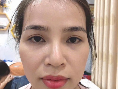 album Cấy HA xóa nhăn