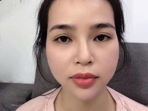 album Cấy HA xóa nhăn