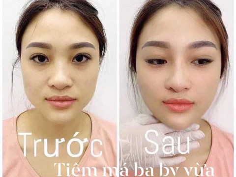 album Cấy HA xóa nhăn